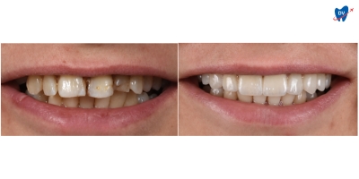 Before and after images of a man who underwent porcelain veneers