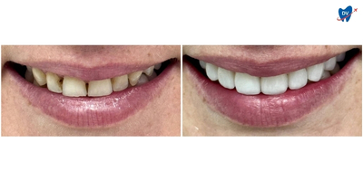 Before and after images of a man's mouth who underwent dental crowns and veneers treatment in Phuket