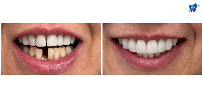 Before and after images of a man's mouth who underwent dental crowns and veneers in Phuket