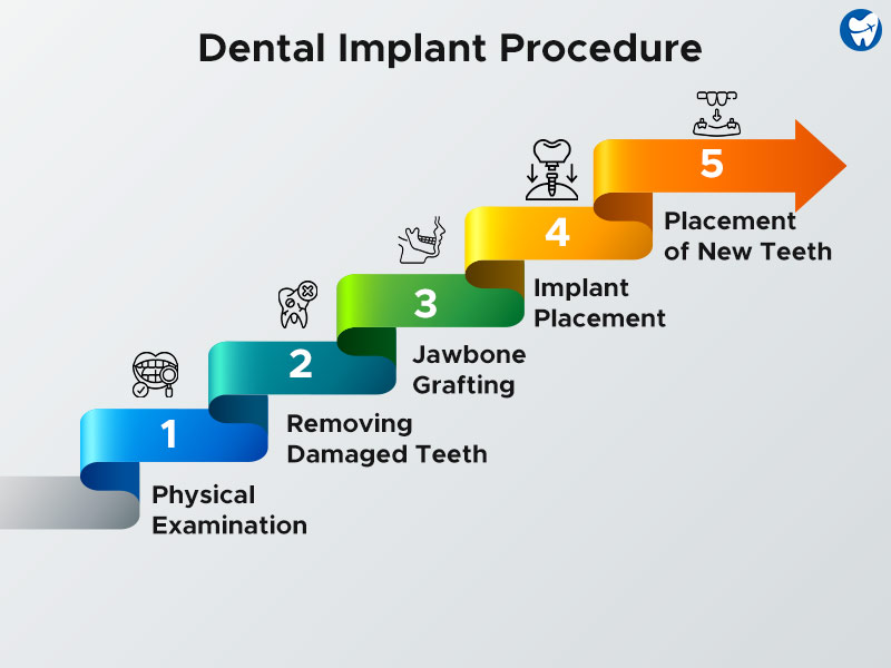 Dental Implant Procedure